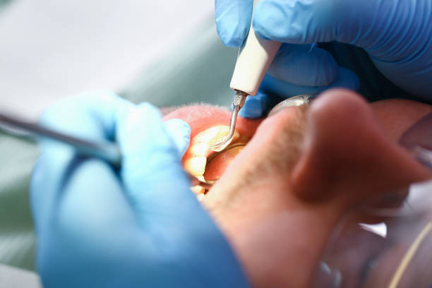 Best Emergency Dental Care for Broken or Chipped Teeth in Southside, AL